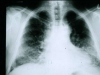 肺瘢痕疾病的新线索可能有助于治疗