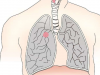 更新：肺癌 EXON 14 突变的 MET 靶向治疗