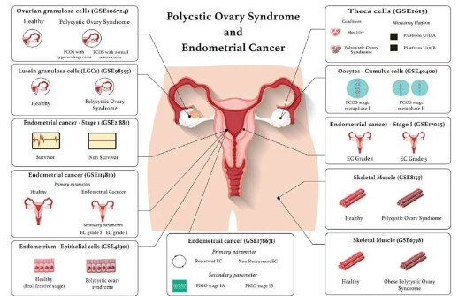 四种新受体可能将子宫内膜癌与多囊卵巢综合症联系起来