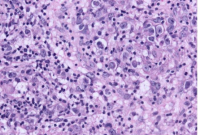 用于预测中枢性尿崩症患者非淋巴细胞病变的新生物标志物