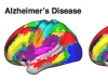研究揭示阿尔茨海默病对大脑功能的更广泛影响
