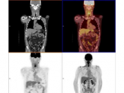 新的成像扫描可追踪持续存在的癌细胞