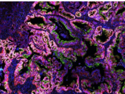 科学家发现粘液可以促进年轻的胰腺癌细胞生长 但也可以防止致命的转变