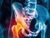 研究人员表示渐进式阻力训练对于髋骨关节炎并不有效
