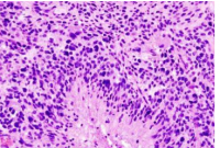 新的 mRNA 癌症疫苗引发强烈的免疫反应来对抗恶性脑肿瘤