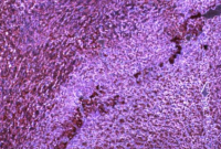 MicroRNA帮助癌症逃避免疫系统