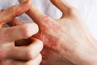 研究人员将 Lebrikizumab 与持续的特应性皮炎治疗效果联系起来