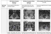 研究表明 MRI 可使直肠癌患者免于手术